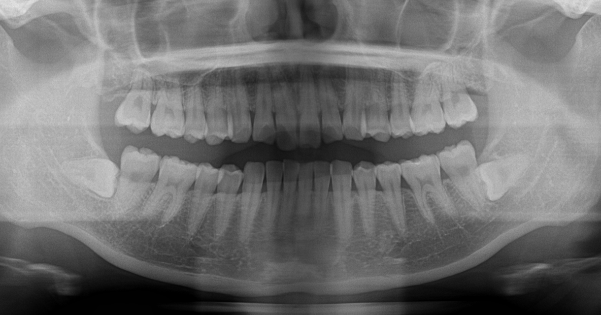 埋まっている親知らずのリスクとは ブログ 美しい歯を手に入れるなら自由が丘シーズ歯科 矯正歯科