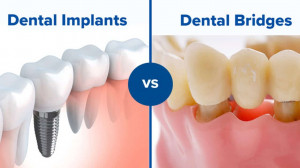 Inner-Page-Dental-Bridges-vs-Implants